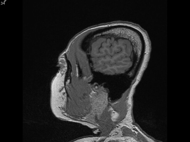 File:Atypical meningioma - intraosseous (Radiopaedia 64915-74572 Sagittal T1 34).jpg