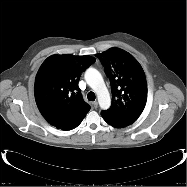 File:Atypical pneumonia - Q fever (Radiopaedia 21993-21989 C+ arterial phase 14).jpg