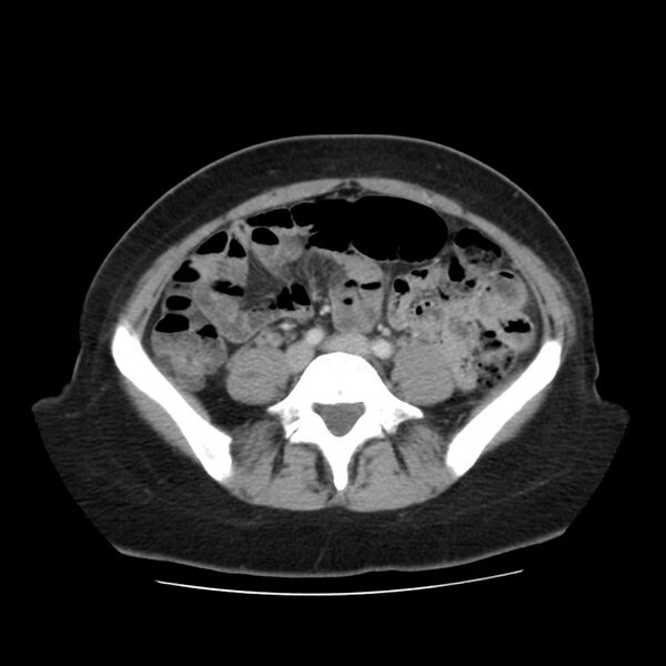 File:Autosomal dominant polycystic kidney disease (Radiopaedia 23061-23093 C 46).jpg