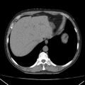 Autosomal dominant polycystic kidney disease (Radiopaedia 36539-38101 Axial non-contrast 12).jpg