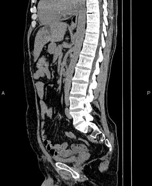 File:Autosomal dominant polycystic kidney disease (Radiopaedia 87830-104287 C 50).jpg