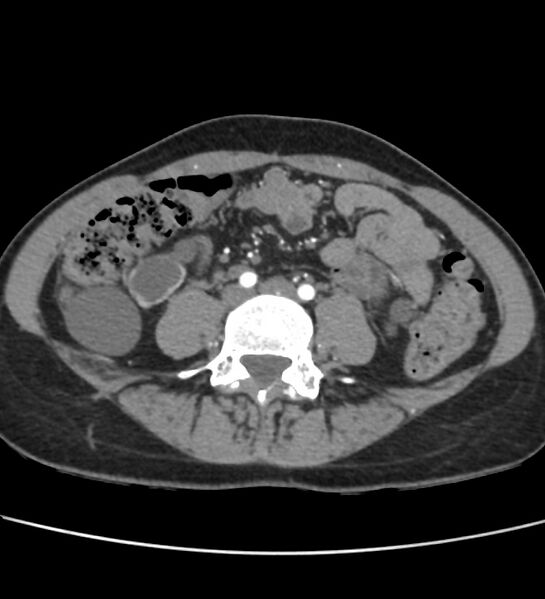 File:Autosomal dominant polycystic kidney disease - early onset (Radiopaedia 40734-43387 B 51).jpg
