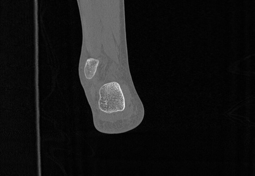 Avulsion fractures of talus and calcaneus (Radiopaedia 48277-53155 Coronal bone window 89).jpg