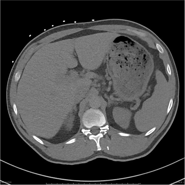 File:Azygos venous system anatomy (CT pulmonary angiography) (Radiopaedia 25928-26077 Axial C+ CTPA 90).jpg