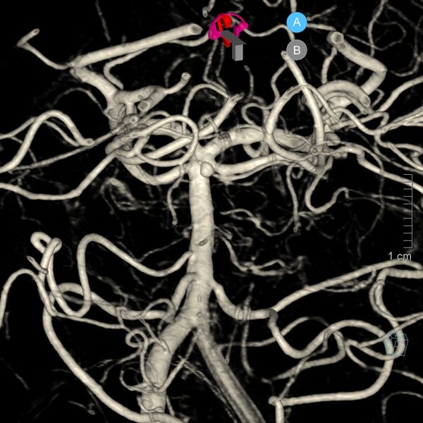 File:Basilar artery perforator aneurysm (Radiopaedia 82455-97734 3D view left VA 1).jpg