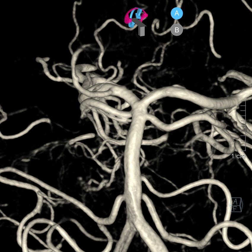Basilar artery perforator aneurysm (Radiopaedia 82455-97734 3D view left VA 111).jpg