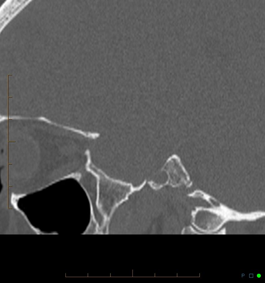 Benign notochordal cell tumor (probable) (Radiopaedia 65475-74546 Sagittal bone window 48).jpg