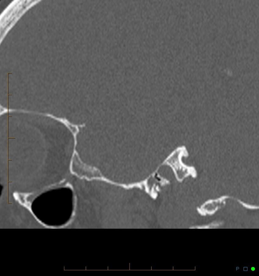 Benign notochordal cell tumor (probable) (Radiopaedia 65475-74546 Sagittal bone window 57).jpg