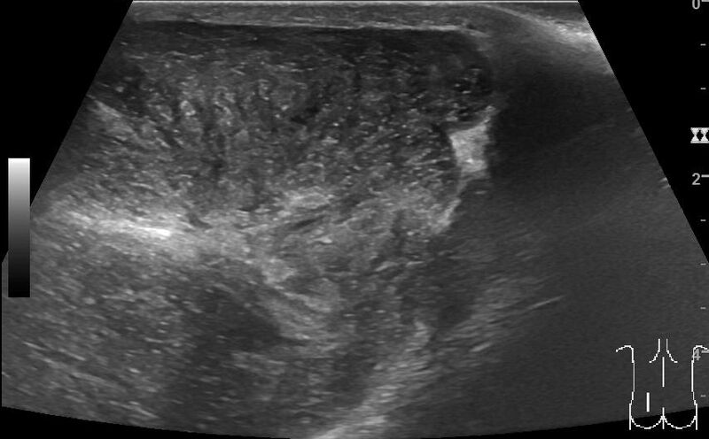 File:Benign peripheral nerve sheath tumor (lumbar subcutaneous region) (Radiopaedia 76171).jpg