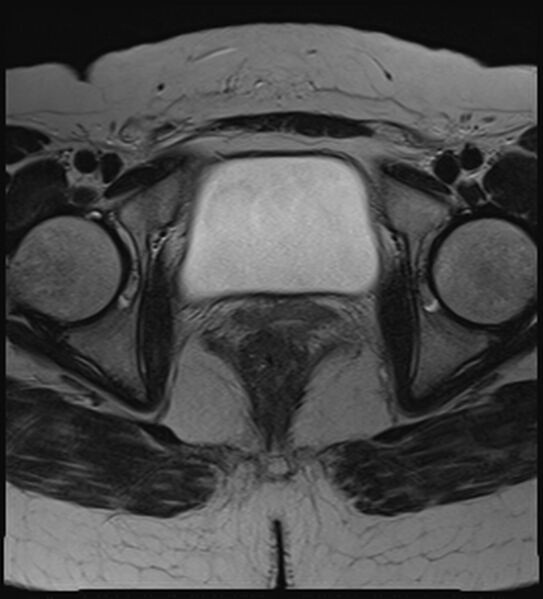 File:Bicornuate, unicollis uterus (Radiopaedia 79468-92593 Axial T2 19).jpg