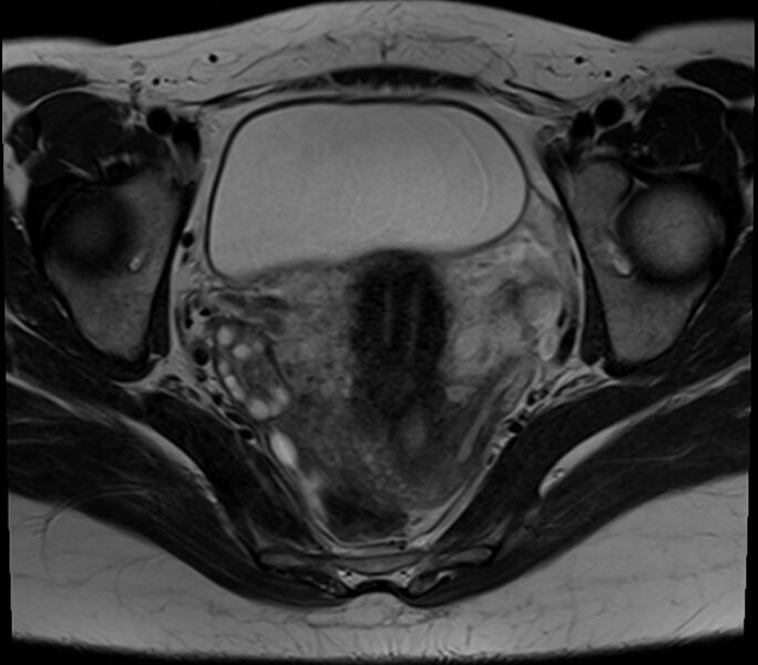 File:Bicornuate uterus (Radiopaedia 71214-81511 Axial T2 15).jpg