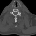 Bilateral C6-7 locked facet dislocation (Radiopaedia 28506-28748 Axial bone window 21).jpeg