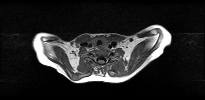 File:Bilateral Sprengel deformity with Klippel-Feil syndrome (Radiopaedia 66395-75650 Axial T1 17).jpg
