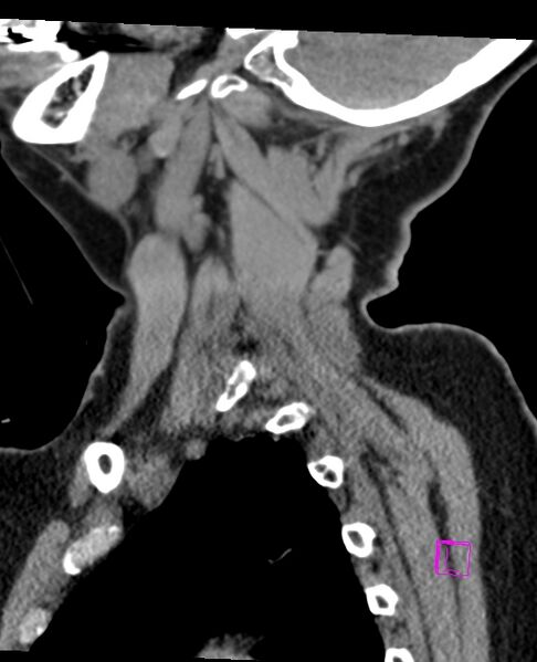 File:Bilateral atlanto-occipital assimilation (Radiopaedia 28350-28603 D 16).jpg