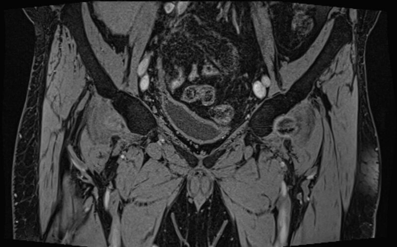 File:Bilateral avascular necrosis of femoral head (Radiopaedia 77116-89078 Coronal T2 we 73).jpg