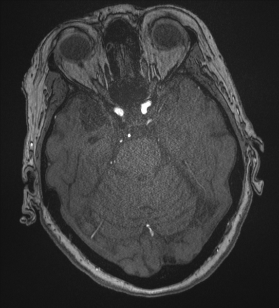File:Bilateral fetal posterior communicating arteries (Radiopaedia 41286-44102 Axial MRA 66).png