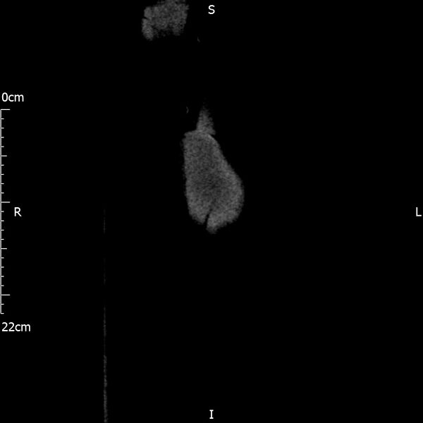 File:Bilateral medullary nephrocalcinosis with ureteric calculi (Radiopaedia 71269-81569 Coronal non-contrast 2).jpg