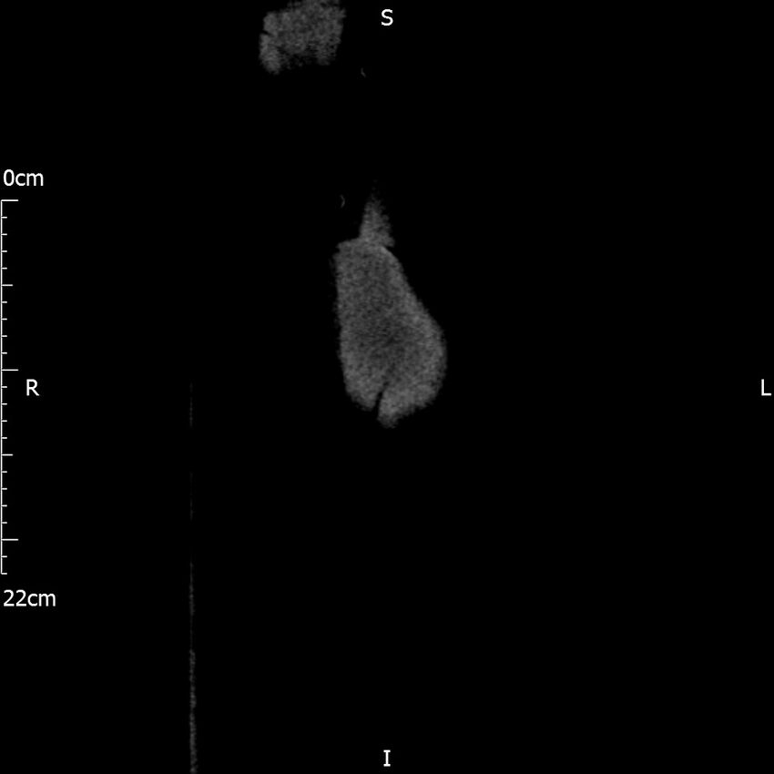 Bilateral medullary nephrocalcinosis with ureteric calculi (Radiopaedia 71269-81569 Coronal non-contrast 2).jpg
