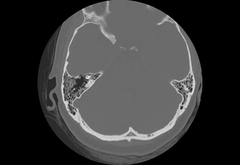 File:Bilateral otospongiosis (Radiopaedia 35447-36940 Axial bone window 44).jpg