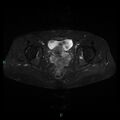 Bilateral ovarian fibroma (Radiopaedia 44568-48293 Axial STIR 19).jpg