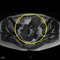 Bilateral ovarian fibroma (Radiopaedia 44568-48293 G 1).jpg