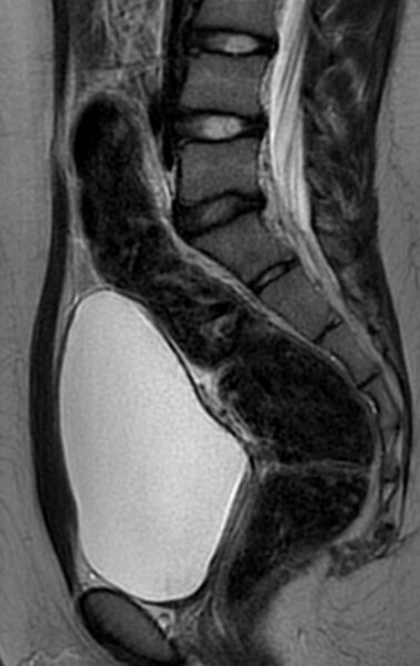 File:Bilateral ovarian fibrothecomas - adolescent (Radiopaedia 86604-102707 Sagittal T2 16).jpg