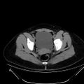 Bilateral ovarian mature cystic teratomas (Radiopaedia 79373-92457 Axial non-contrast 75).jpg