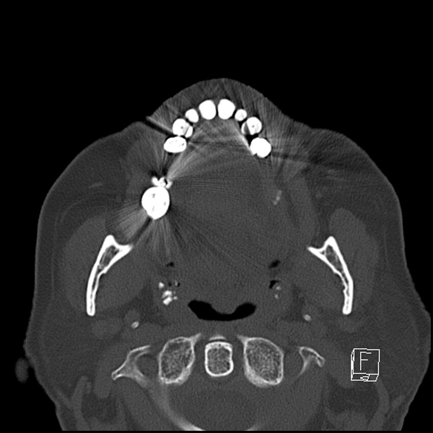 Bilateral palatine tonsilloliths on OPG and CT (Radiopaedia 75167-86247 Axial bone window 38).jpg