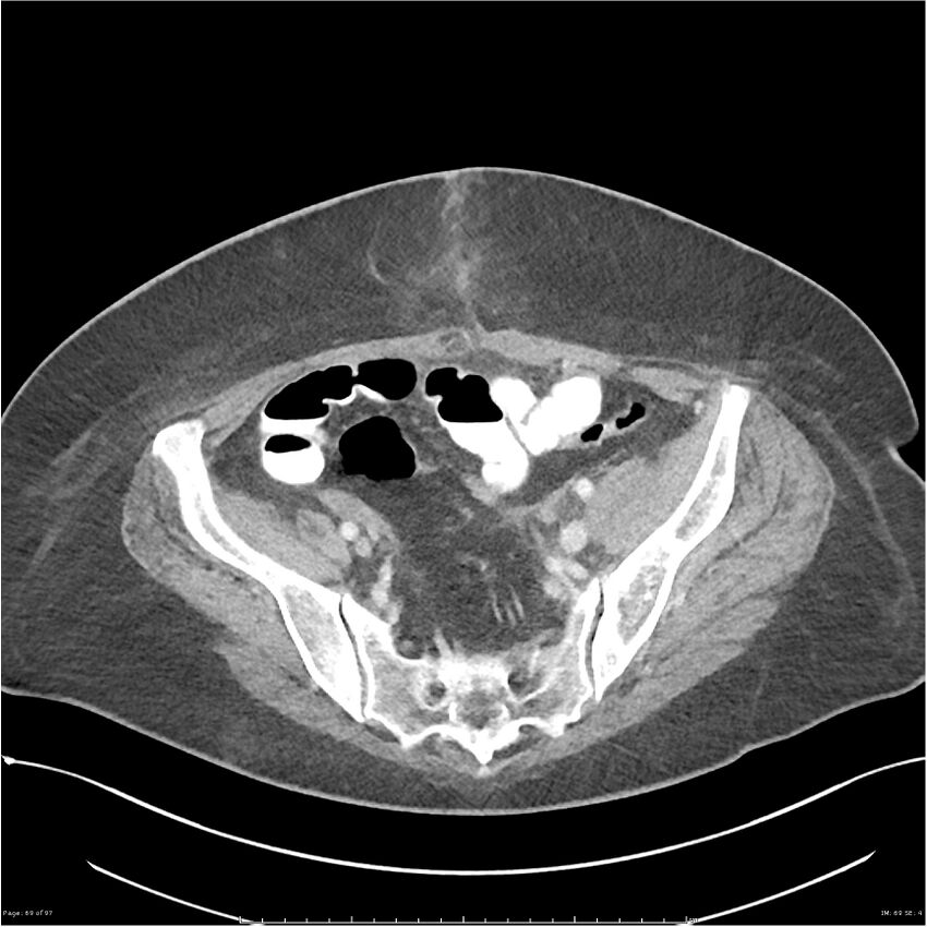 Bilateral psoas hematomas (Radiopaedia 24057-24279 A 69).jpg