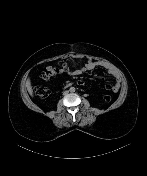 File:Bilateral sporadic synchronous clear cell renal cell carcinoma (Radiopaedia 85035-100572 Axial non-contrast 38).jpg