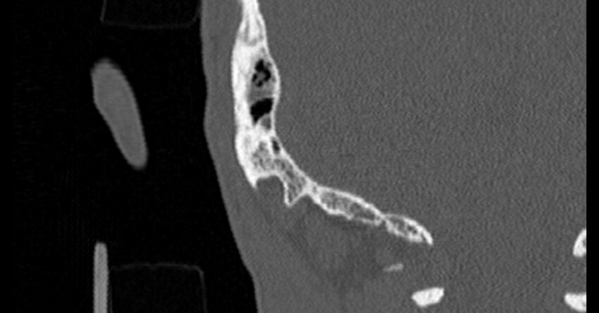 Bilateral temporal bone fractures (Radiopaedia 29482-29970 Coronal non-contrast 183).jpg