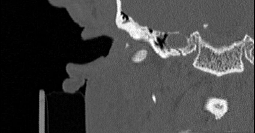 Bilateral temporal bone fractures (Radiopaedia 29482-29970 Coronal non-contrast 74).jpg