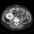 Biliary necrosis - liver transplant (Radiopaedia 21876-21846 B 48).jpg