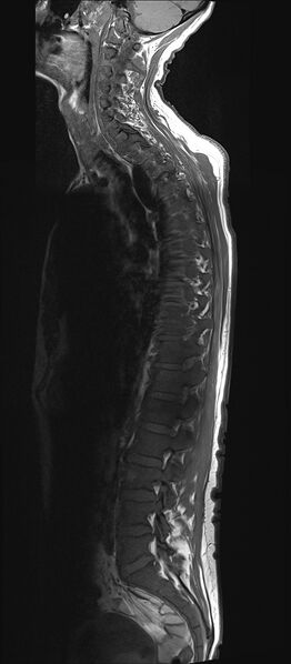 File:Bing-Neel syndrome (Radiopaedia 71453-81799 Sagittal T1 3).jpg