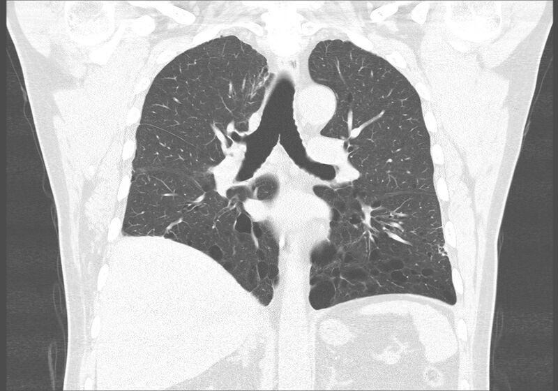 File:Birt-Hogg-Dubé syndrome (Radiopaedia 52578-58491 Coronal lung window 33).jpg
