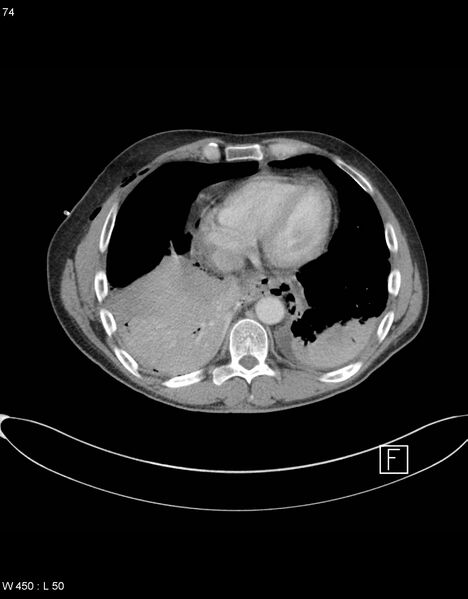 File:Boerhaave syndrome with tension pneumothorax (Radiopaedia 56794-63605 A 36).jpg