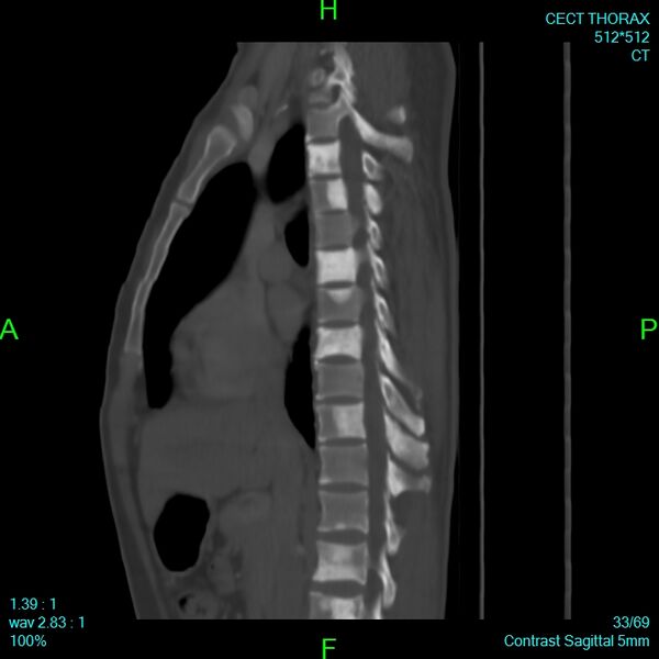 File:Bone metastases from lung carcinoma (Radiopaedia 54703-60937 Sagittal bone window 33).jpg