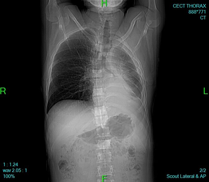 File:Bone metastases from lung carcinoma (Radiopaedia 54703-60937 Scanogram 1).jpg