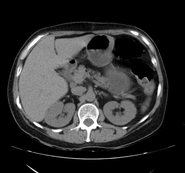 File:Bosniak renal cyst - type IV (Radiopaedia 22929-22953 Axial non-contrast 16).jpg