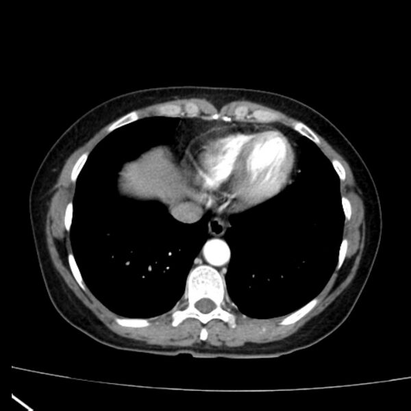 File:Bosniak renal cyst - type I (Radiopaedia 27479-27675 renal cortical phase 3).jpg