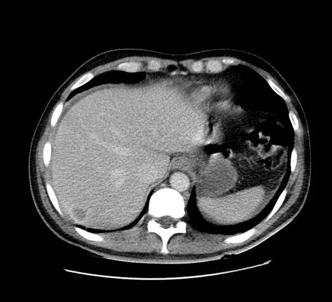 File:Bowel obstruction from colon carcinoma (Radiopaedia 22995-23028 A 13).jpg