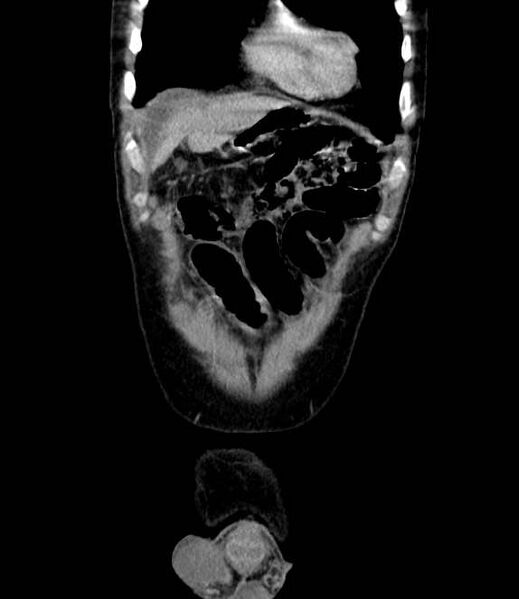 File:Bowel obstruction from colon carcinoma (Radiopaedia 22995-23028 C 10).jpg