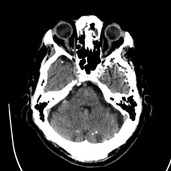 File:Brain Pantopaque remnants (Radiopaedia 78403-91048 Axial non-contrast 33).jpg