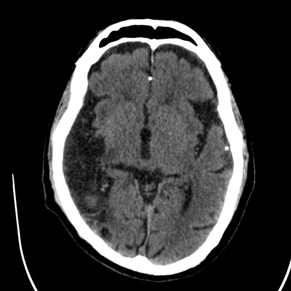 File:Brain Pantopaque remnants (Radiopaedia 78403-91048 Axial non-contrast 48).jpg