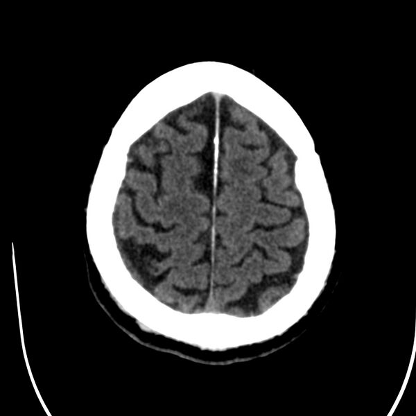 File:Brain Pantopaque remnants (Radiopaedia 78403-91048 Axial non-contrast 75).jpg