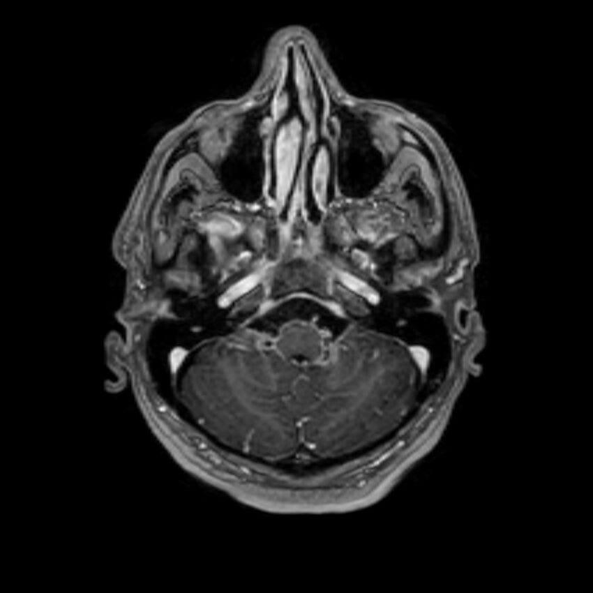 Brain abscess complicated by intraventricular rupture and ventriculitis (Radiopaedia 82434-96577 Axial T1 C+ 9).jpg