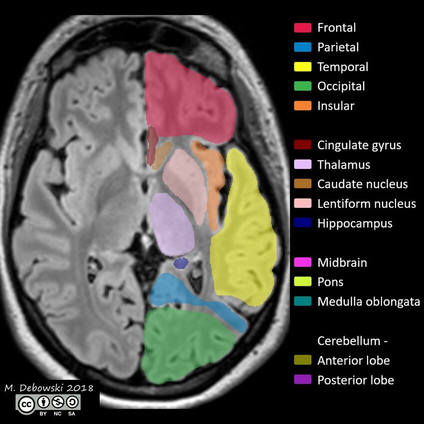 Brain lobes - annotated MRI (Radiopaedia 61691-69700 Axial 40).JPG