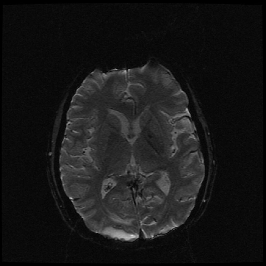 Brain metastases (renal cell carcinoma) (Radiopaedia 42571-45704 Axial SWI 30).jpg