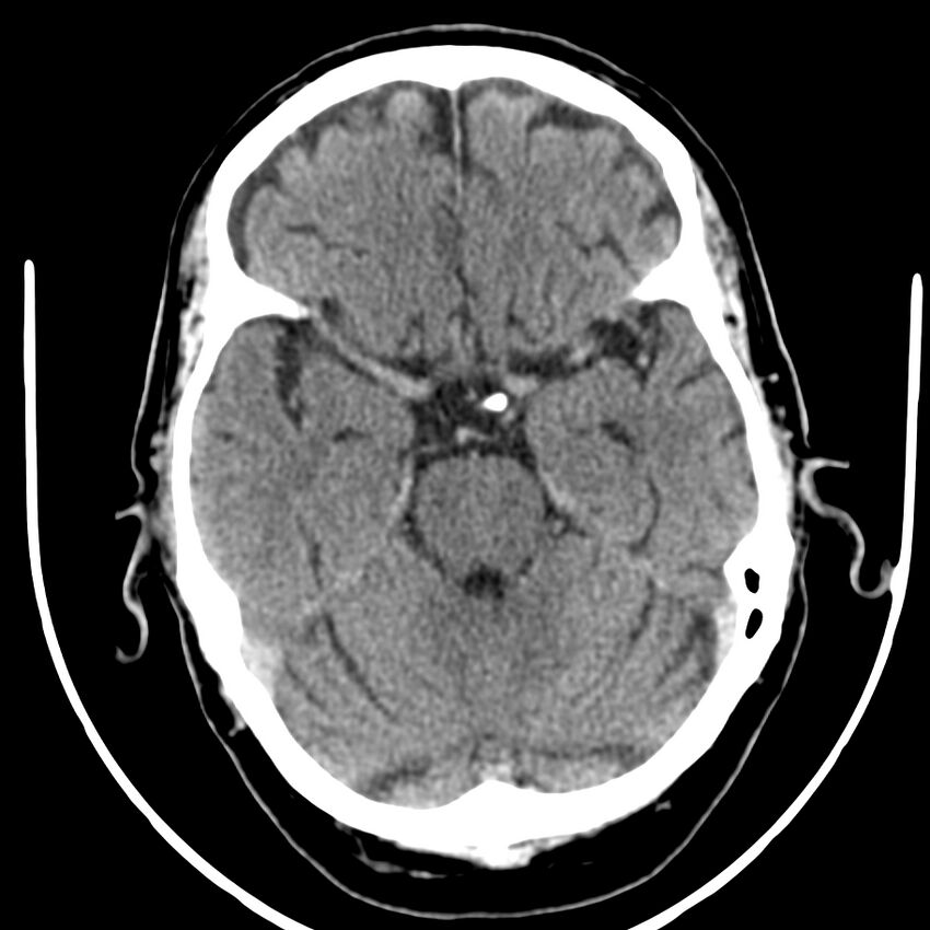 Brain metastasis (Radiopaedia 42617-45760 Axial non-contrast 14).jpg