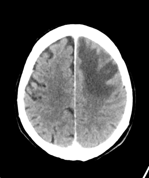 File:Brain metastasis (lung cancer) (Radiopaedia 48289-53177 Axial C+ 24).png